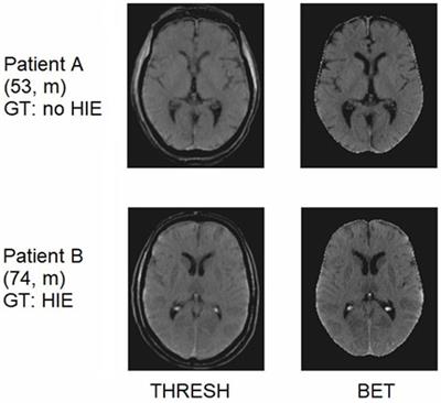Deep learning-enabled detection of hypoxic–ischemic encephalopathy after cardiac arrest in CT scans: a comparative study of 2D and 3D approaches